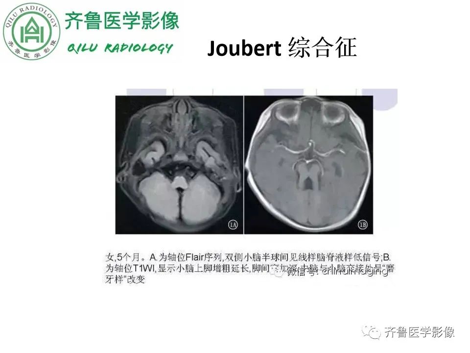 影像PPT - 【病例】胼胝体发育不良2例影像诊断-31