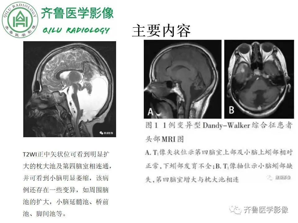 影像PPT - 【病例】胼胝体发育不良2例影像诊断-37
