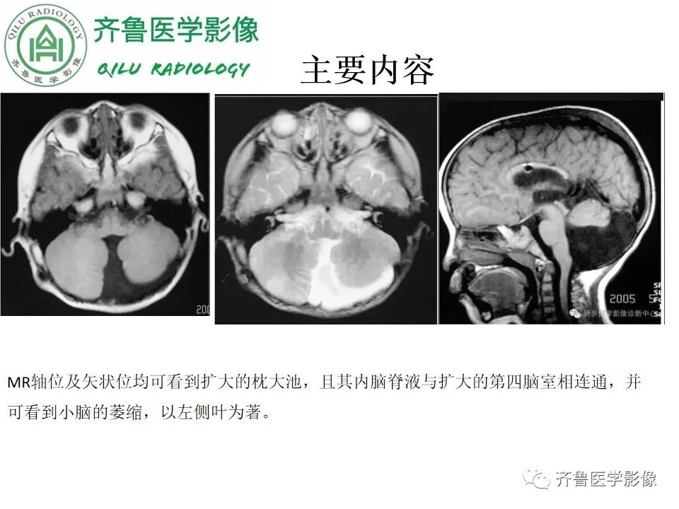 影像PPT - 【病例】胼胝体发育不良2例影像诊断-36