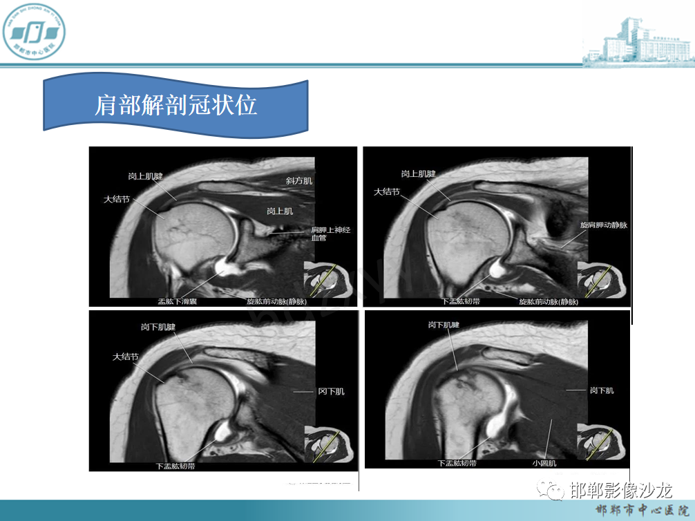 影像PPT - 【PPT】肩周炎和肩袖损伤的鉴别-4