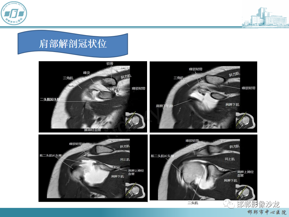 影像PPT - 【PPT】肩周炎和肩袖损伤的鉴别-3