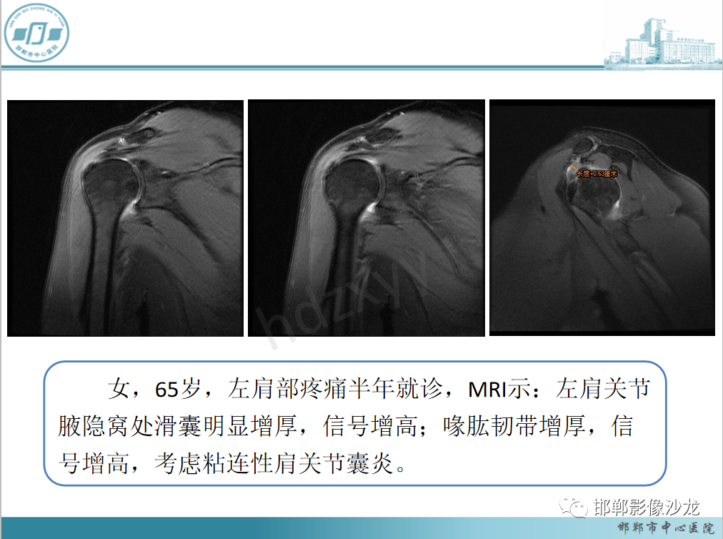 影像PPT - 【PPT】肩周炎和肩袖损伤的鉴别-10