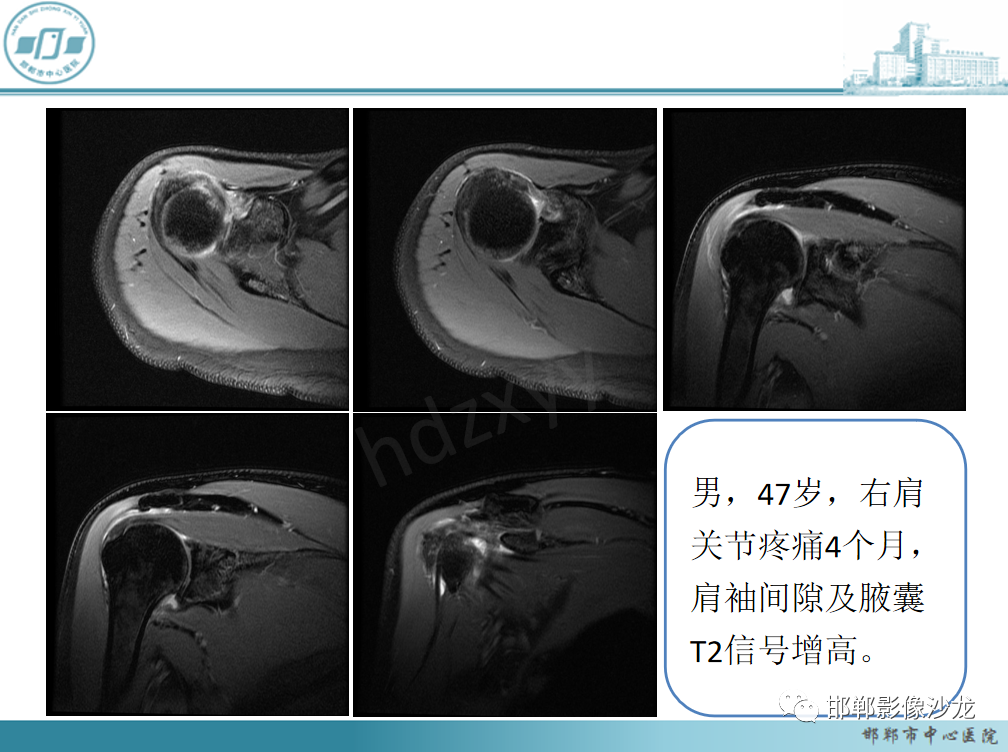 影像PPT - 【PPT】肩周炎和肩袖损伤的鉴别-11