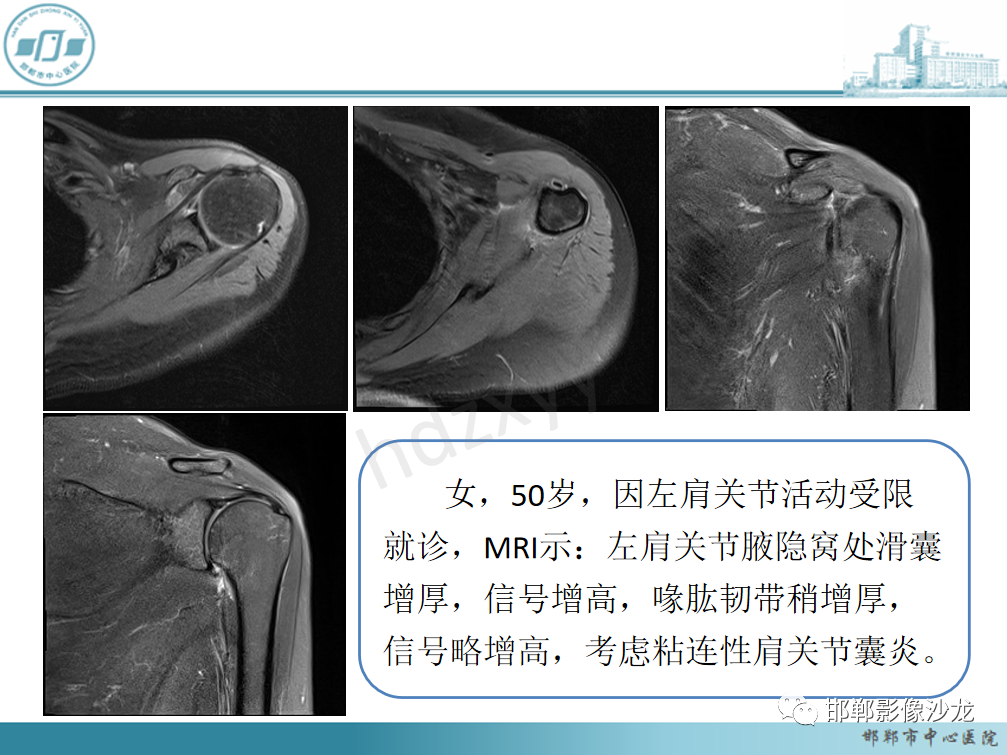 影像PPT - 【PPT】肩周炎和肩袖损伤的鉴别-12
