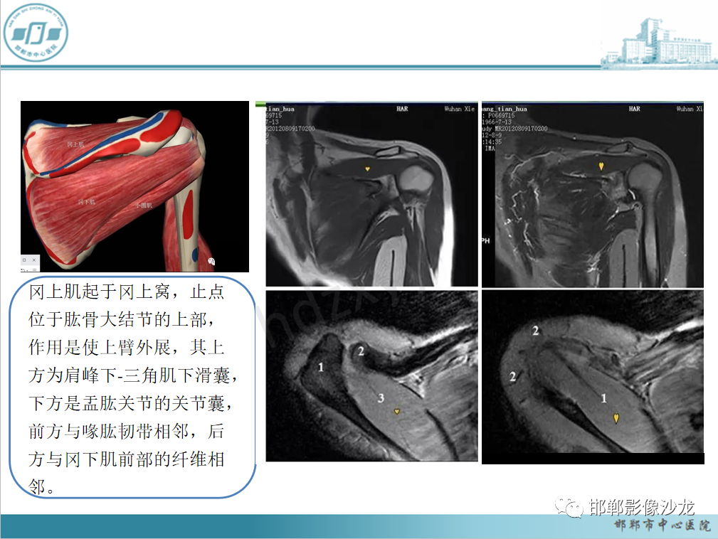 影像PPT - 【PPT】肩周炎和肩袖损伤的鉴别-16