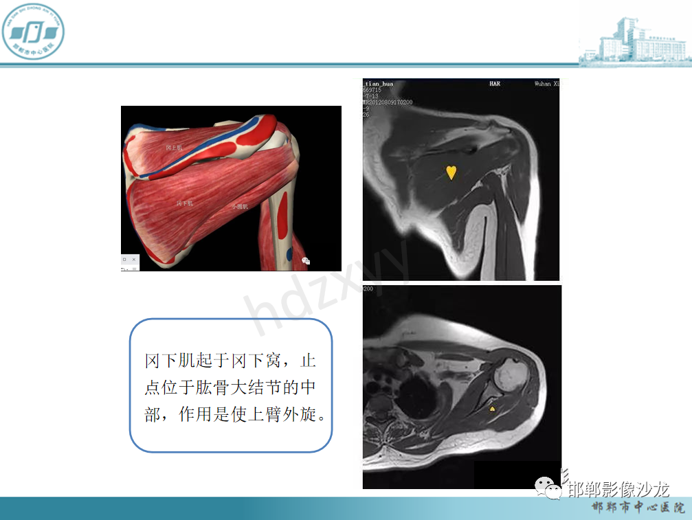 影像PPT - 【PPT】肩周炎和肩袖损伤的鉴别-17