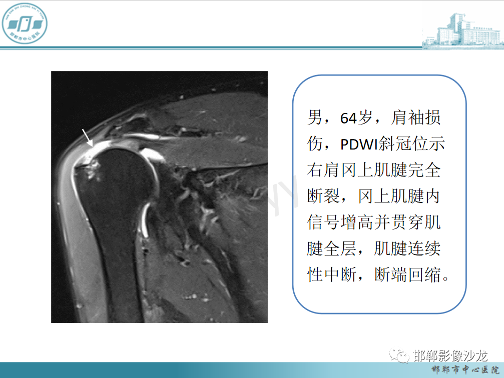 影像PPT - 【PPT】肩周炎和肩袖损伤的鉴别-25