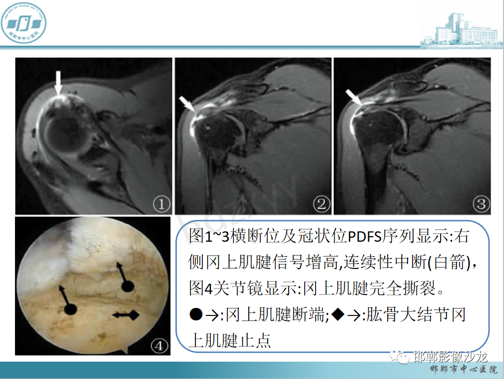 影像PPT - 【PPT】肩周炎和肩袖损伤的鉴别-26