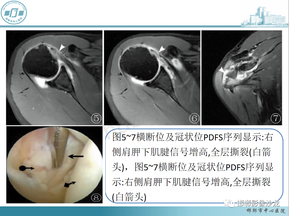 影像PPT - 【PPT】肩周炎和肩袖损伤的鉴别-27