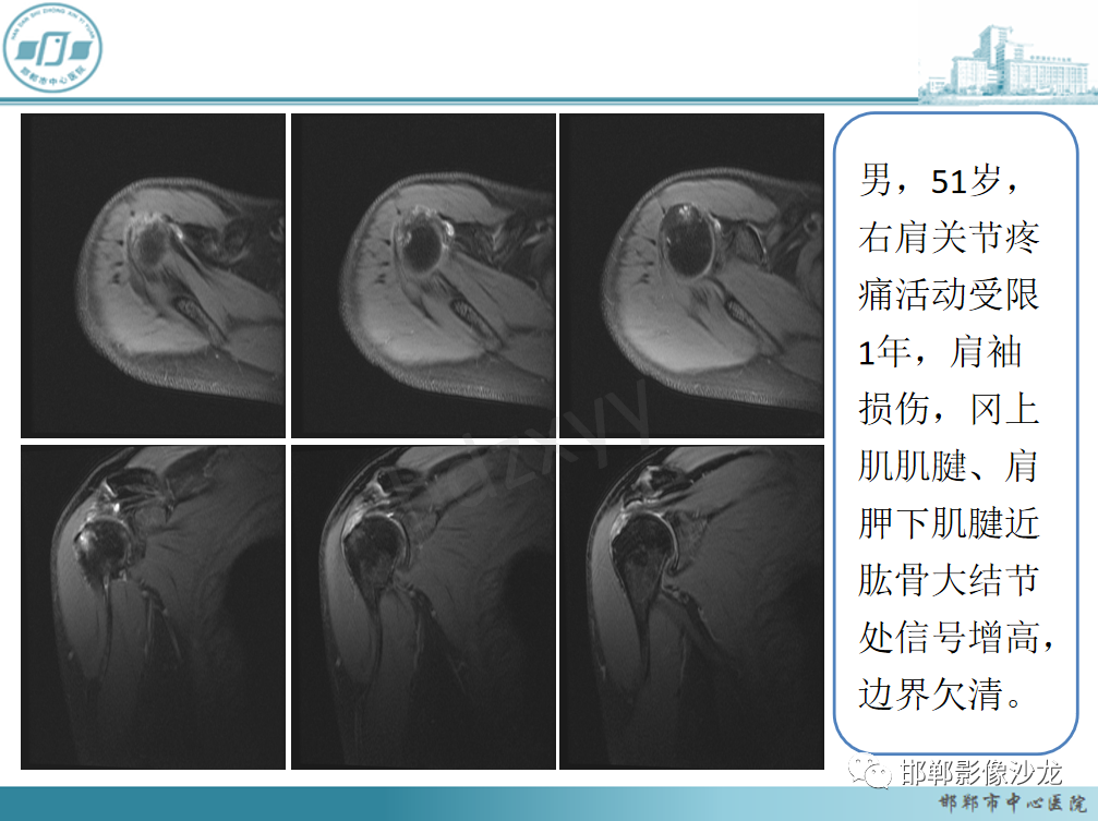 影像PPT - 【PPT】肩周炎和肩袖损伤的鉴别-28