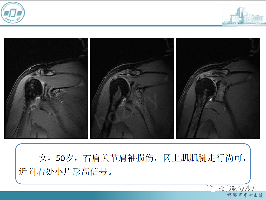 影像PPT - 【PPT】肩周炎和肩袖损伤的鉴别-29