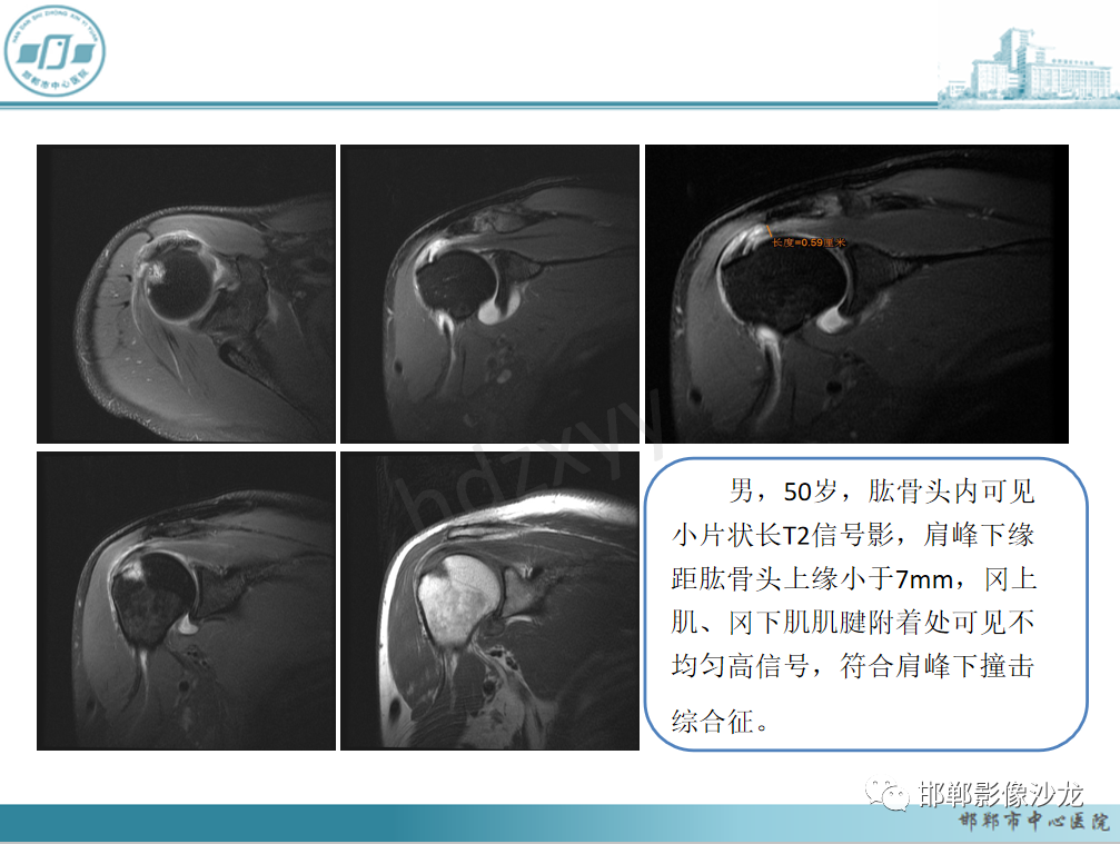 影像PPT - 【PPT】肩周炎和肩袖损伤的鉴别-34