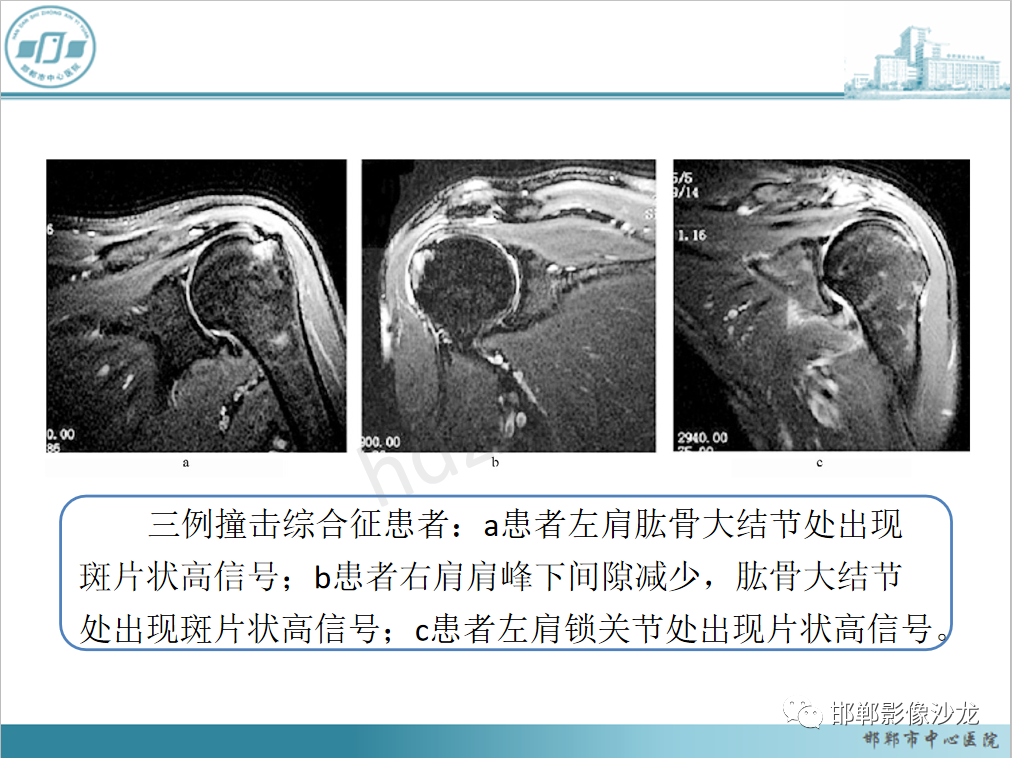 影像PPT - 【PPT】肩周炎和肩袖损伤的鉴别-35
