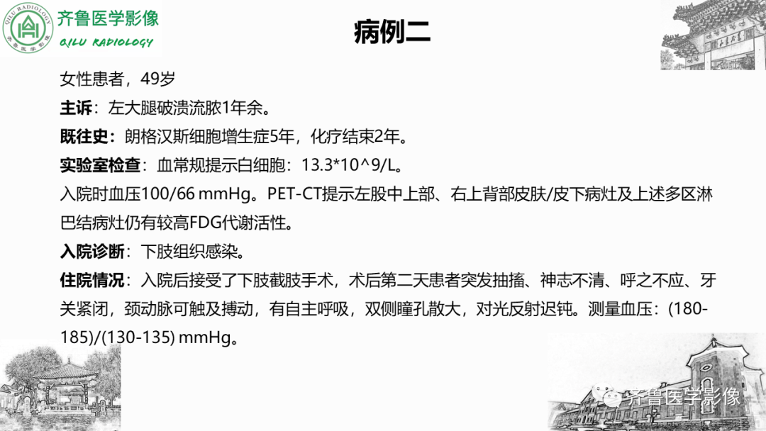 影像PPT - 【PPT】可逆性后部脑病综合征PRES二例影像-9