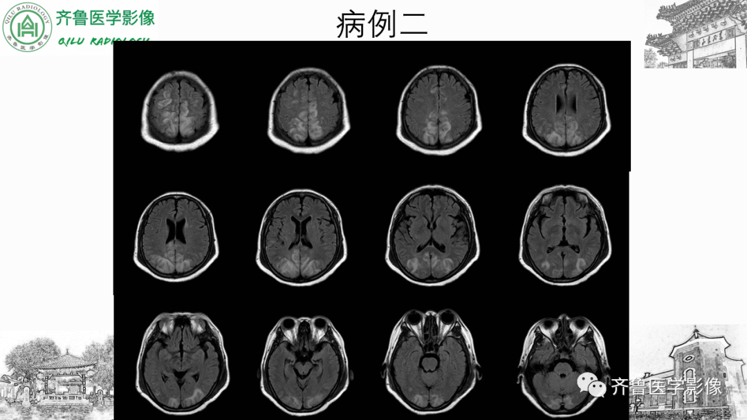 影像PPT - 【PPT】可逆性后部脑病综合征PRES二例影像-12