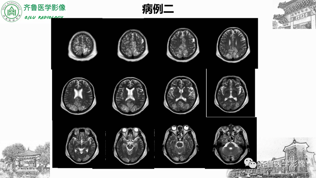 影像PPT - 【PPT】可逆性后部脑病综合征PRES二例影像-10