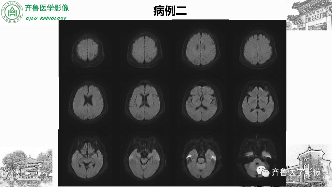 影像PPT - 【PPT】可逆性后部脑病综合征PRES二例影像-13