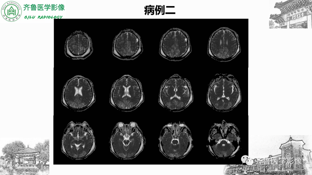 影像PPT - 【PPT】可逆性后部脑病综合征PRES二例影像-14