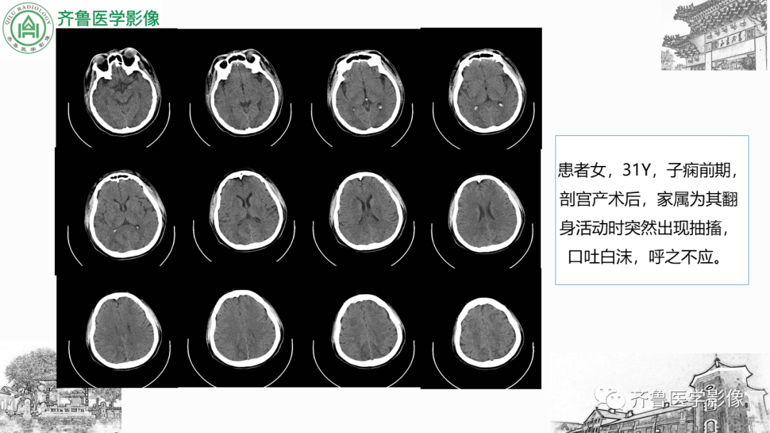 影像PPT - 【PPT】可逆性后部脑病综合征PRES二例影像-22