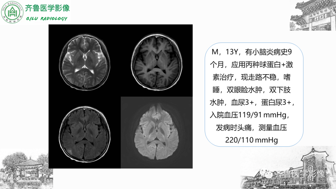 影像PPT - 【PPT】可逆性后部脑病综合征PRES二例影像-25