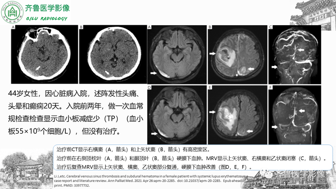 影像PPT - 【PPT】可逆性后部脑病综合征PRES二例影像-33