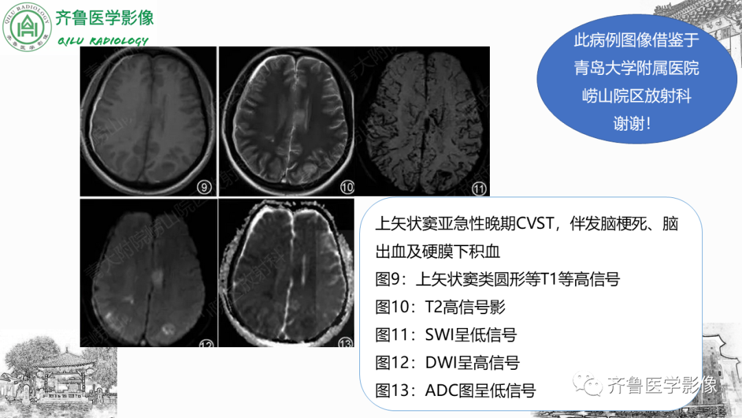 影像PPT - 【PPT】可逆性后部脑病综合征PRES二例影像-34