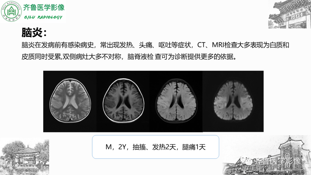 影像PPT - 【PPT】可逆性后部脑病综合征PRES二例影像-35