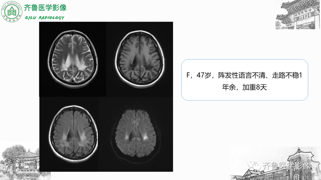影像PPT - 【PPT】可逆性后部脑病综合征PRES二例影像-37
