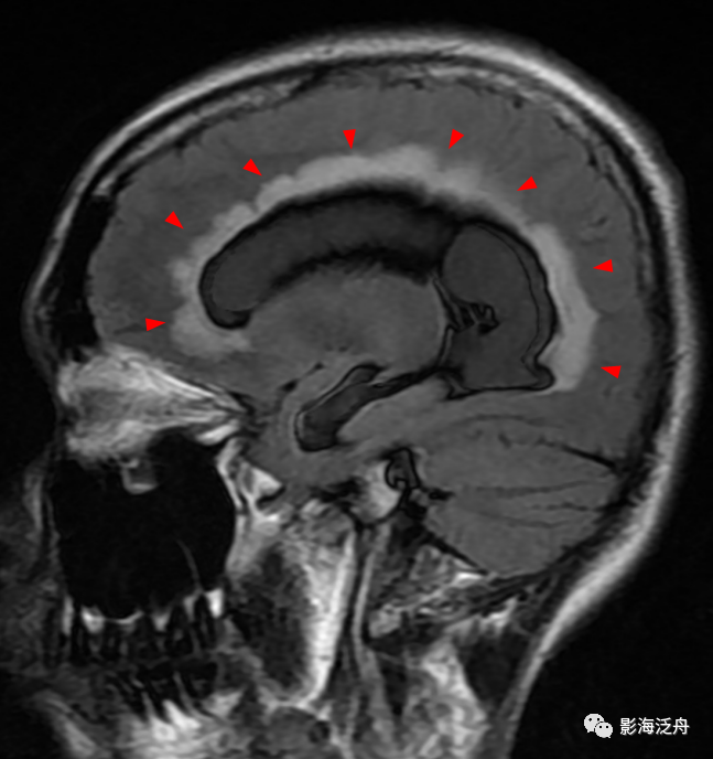 影像PPT - 分析蛛网膜下腔出血真没那么简单-16 影像PPT - 分析蛛网膜下腔出血真没那么简单-16