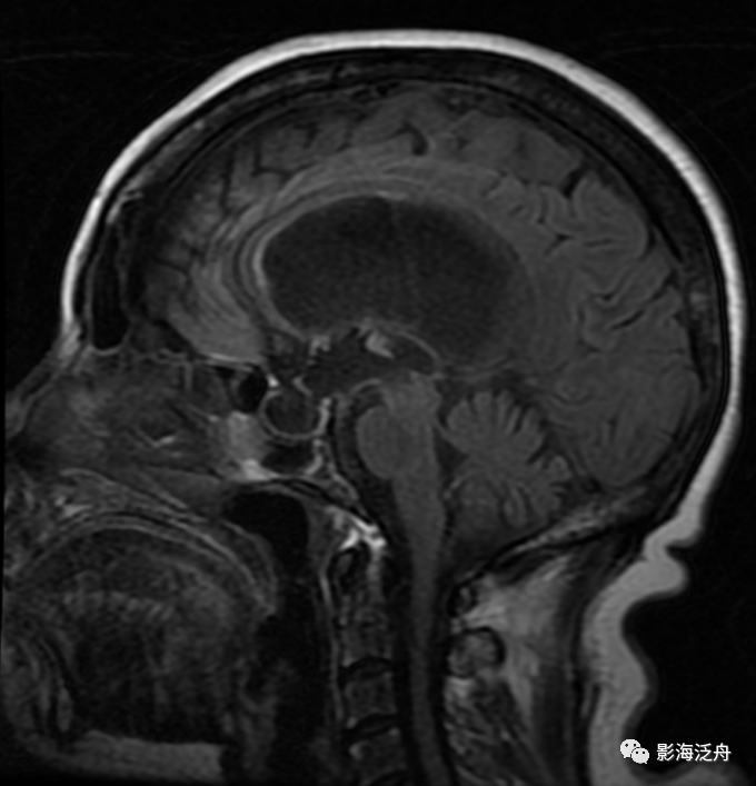 影像PPT - 分析蛛网膜下腔出血真没那么简单-17 影像PPT - 分析蛛网膜下腔出血真没那么简单-17