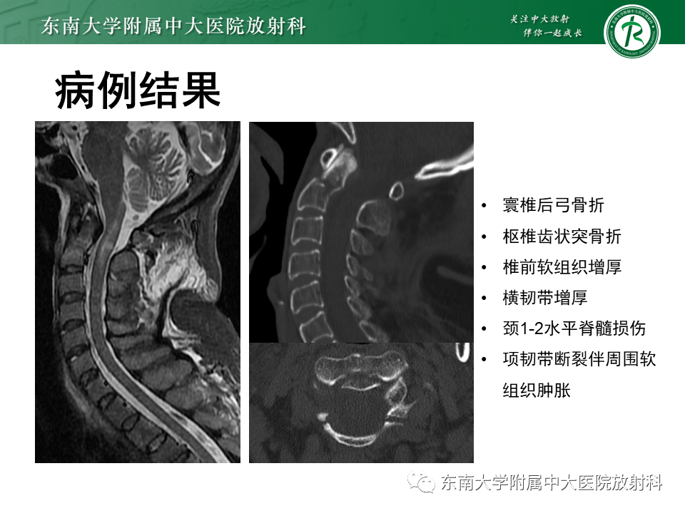 影像PPT - 【PPT】上颈椎骨折影像学评估-3 影像PPT - 【PPT】上颈椎骨折影像学评估-3