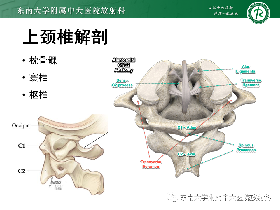 影像PPT - 【PPT】上颈椎骨折影像学评估-5 影像PPT - 【PPT】上颈椎骨折影像学评估-5