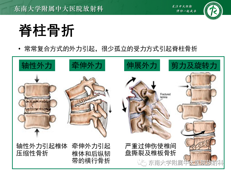 影像PPT - 【PPT】上颈椎骨折影像学评估-7 影像PPT - 【PPT】上颈椎骨折影像学评估-7