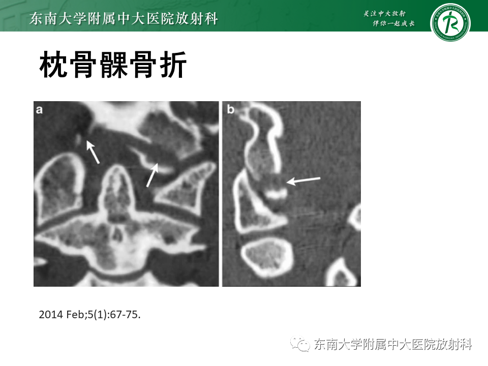 影像PPT - 【PPT】上颈椎骨折影像学评估-6 影像PPT - 【PPT】上颈椎骨折影像学评估-6