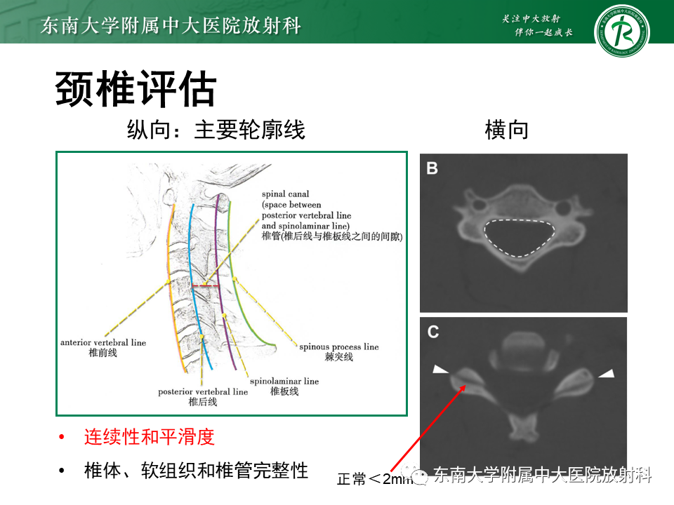 影像PPT - 【PPT】上颈椎骨折影像学评估-9 影像PPT - 【PPT】上颈椎骨折影像学评估-9