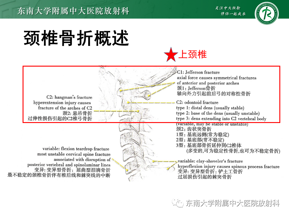 影像PPT - 【PPT】上颈椎骨折影像学评估-12 影像PPT - 【PPT】上颈椎骨折影像学评估-12
