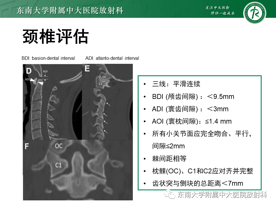 影像PPT - 【PPT】上颈椎骨折影像学评估-10 影像PPT - 【PPT】上颈椎骨折影像学评估-10