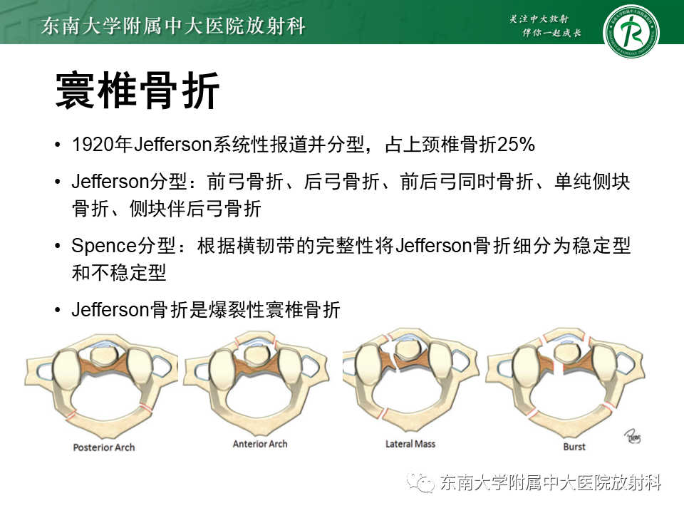 影像PPT - 【PPT】上颈椎骨折影像学评估-13 影像PPT - 【PPT】上颈椎骨折影像学评估-13