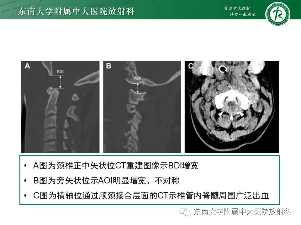 影像PPT - 【PPT】上颈椎骨折影像学评估-11 影像PPT - 【PPT】上颈椎骨折影像学评估-11