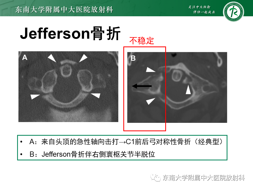 影像PPT - 【PPT】上颈椎骨折影像学评估-14 影像PPT - 【PPT】上颈椎骨折影像学评估-14