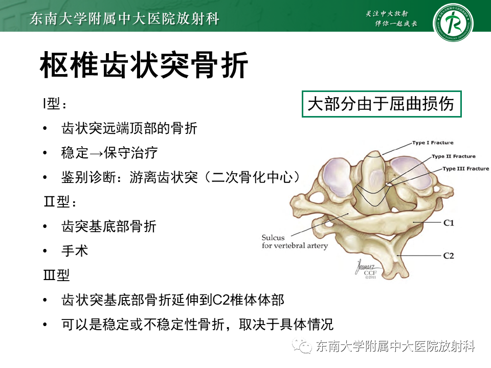 影像PPT - 【PPT】上颈椎骨折影像学评估-15 影像PPT - 【PPT】上颈椎骨折影像学评估-15