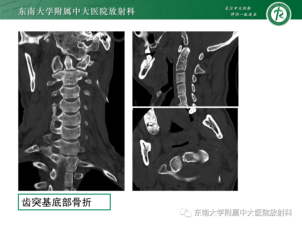 影像PPT - 【PPT】上颈椎骨折影像学评估-16 影像PPT - 【PPT】上颈椎骨折影像学评估-16