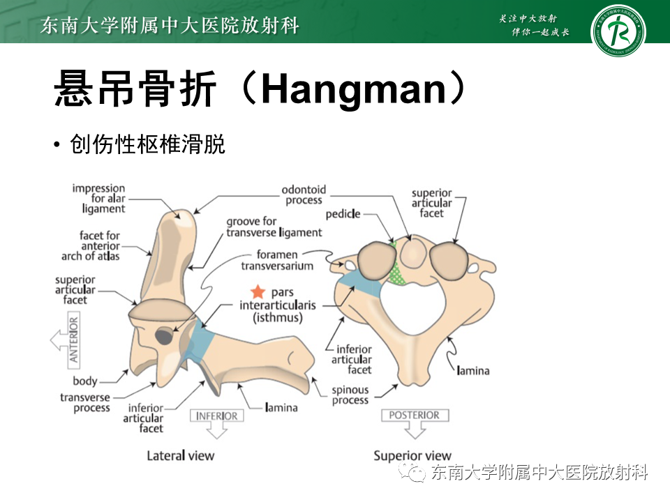 影像PPT - 【PPT】上颈椎骨折影像学评估-18 影像PPT - 【PPT】上颈椎骨折影像学评估-18
