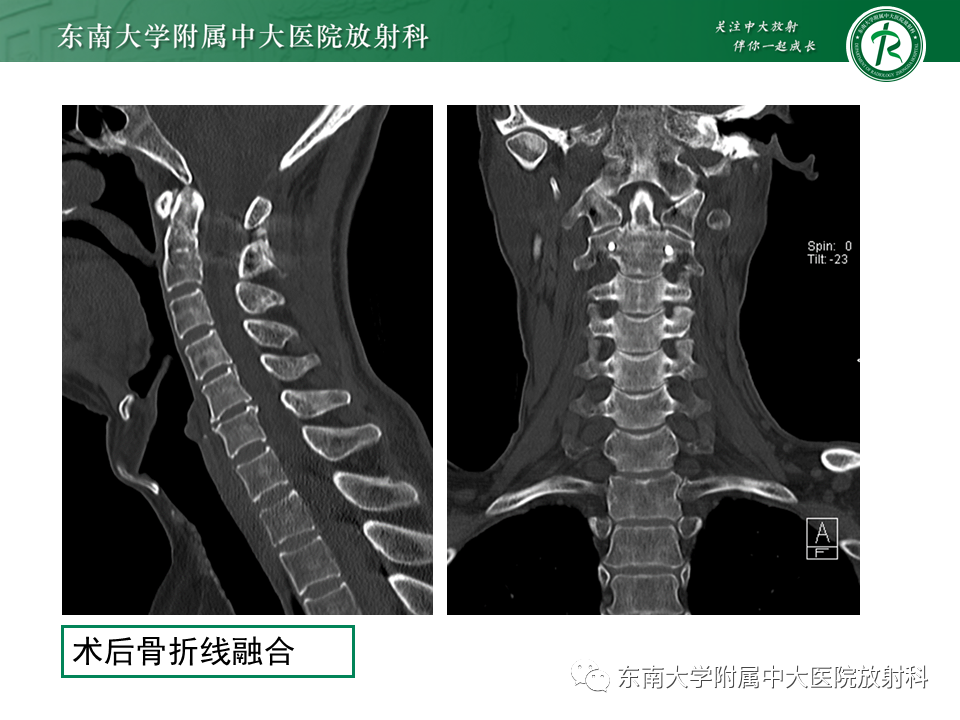 影像PPT - 【PPT】上颈椎骨折影像学评估-17 影像PPT - 【PPT】上颈椎骨折影像学评估-17