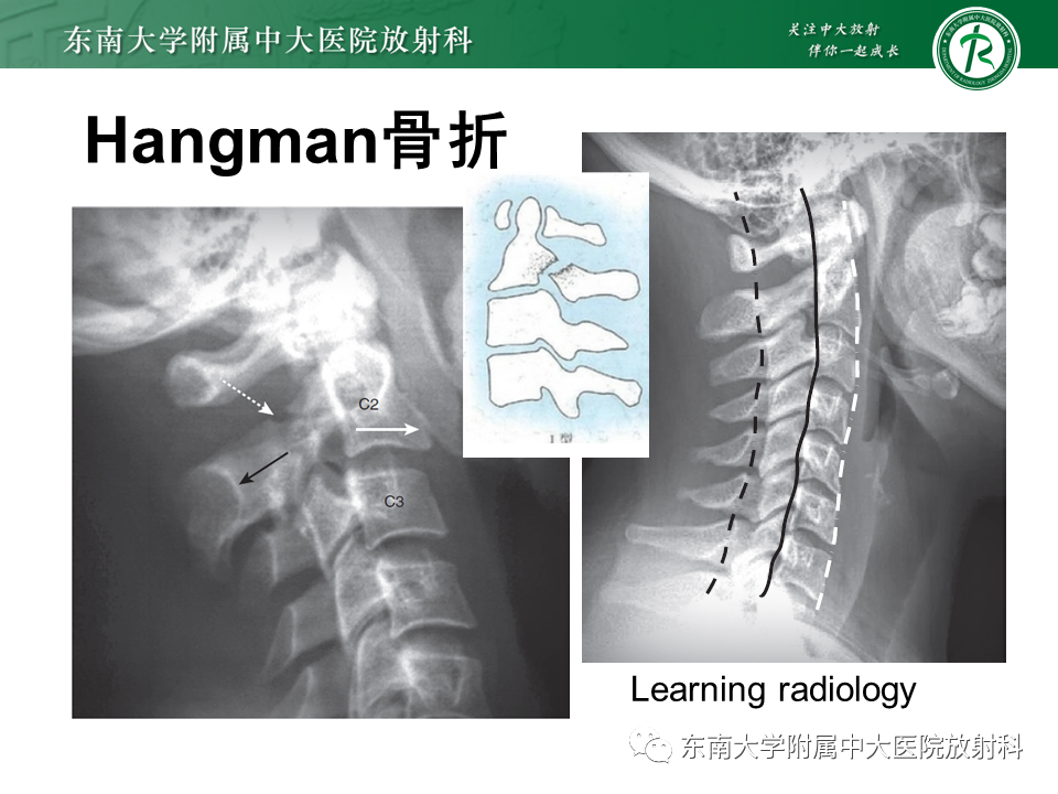 影像PPT - 【PPT】上颈椎骨折影像学评估-20 影像PPT - 【PPT】上颈椎骨折影像学评估-20