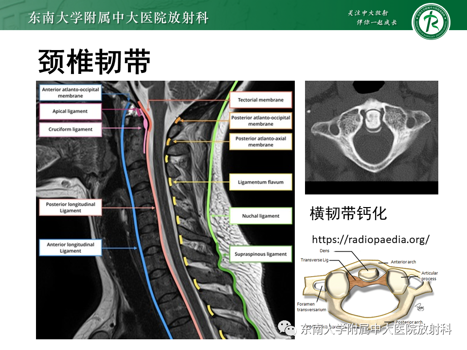 影像PPT - 【PPT】上颈椎骨折影像学评估-23 影像PPT - 【PPT】上颈椎骨折影像学评估-23