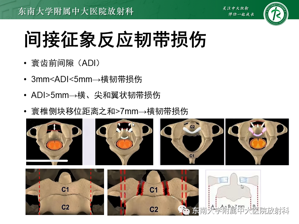 影像PPT - 【PPT】上颈椎骨折影像学评估-24 影像PPT - 【PPT】上颈椎骨折影像学评估-24