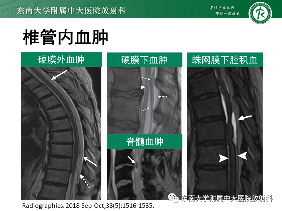 影像PPT - 【PPT】上颈椎骨折影像学评估-29 影像PPT - 【PPT】上颈椎骨折影像学评估-29
