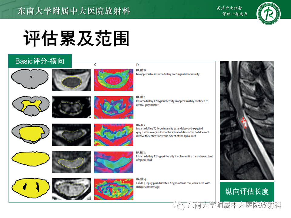 影像PPT - 【PPT】上颈椎骨折影像学评估-27 影像PPT - 【PPT】上颈椎骨折影像学评估-27