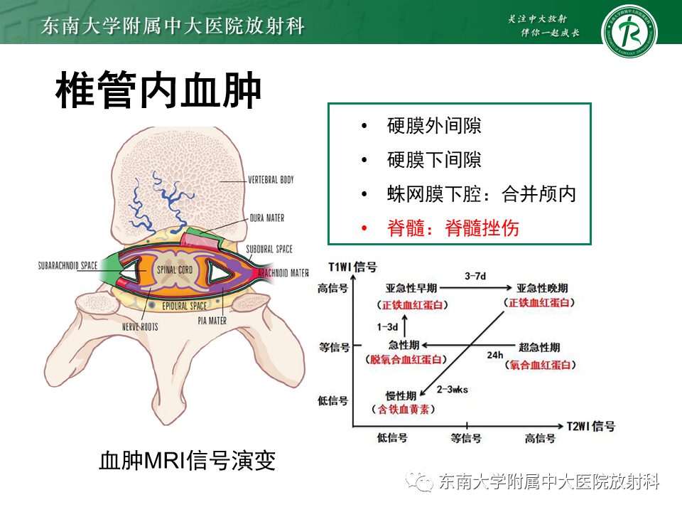 影像PPT - 【PPT】上颈椎骨折影像学评估-28 影像PPT - 【PPT】上颈椎骨折影像学评估-28